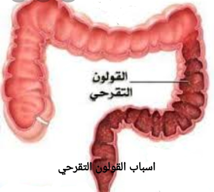 اعراض التهاب القولون - حالات التهاب القولون 3450 1