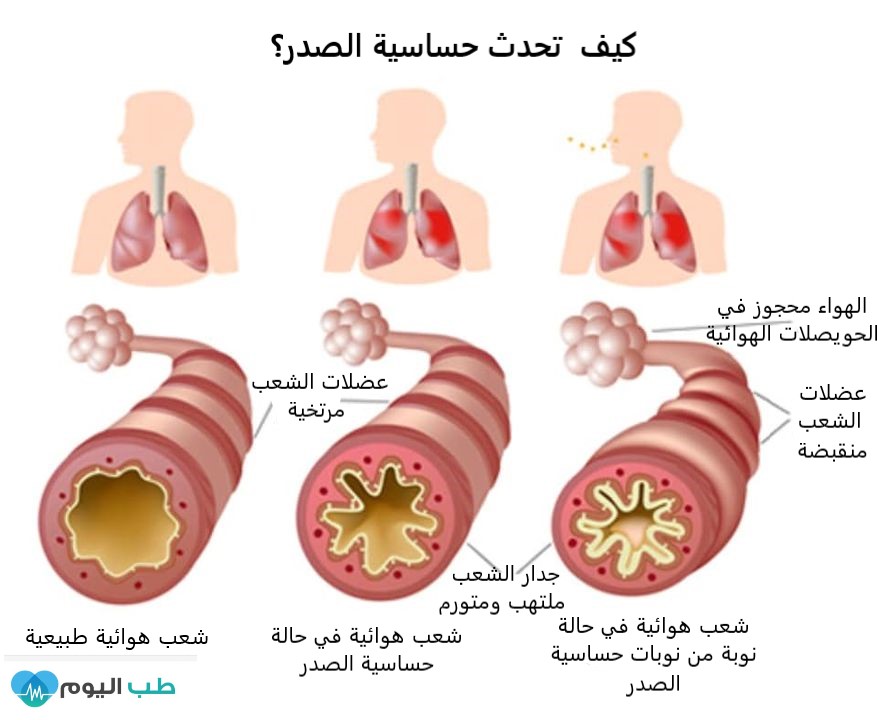 افضل علاج لحساسيه الصدر - هذا المشروب سيجعلك تتخلص من حساسية الصدر 11416 3