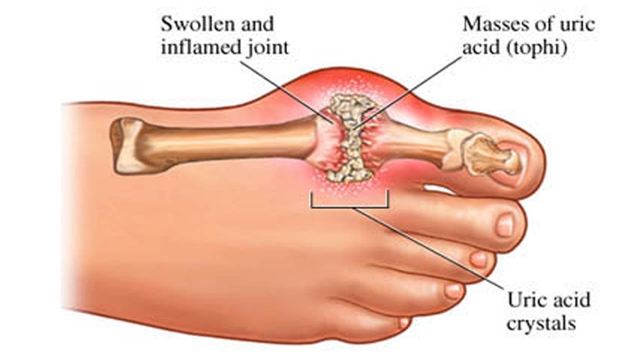 ما هو مرض النقرس , افضل ما قيل عن مرض النقرس