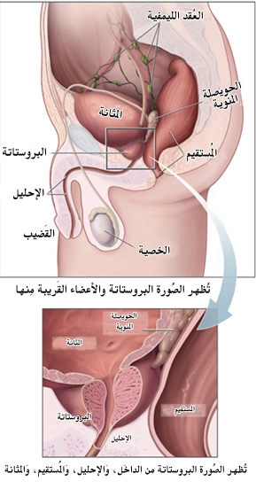 اسباب تضخم البروستاتا - التهاب البروستاتا 3492 4