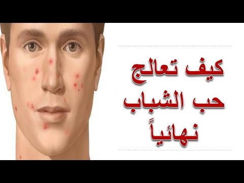 كيف تعالج حب الشباب - القضاء علي حب الشباب نهائيا 11341 3