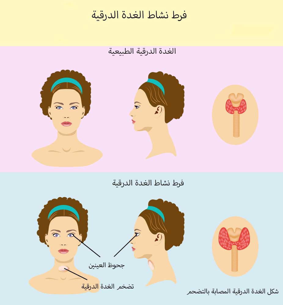 اعراض الغدة الدرقية , اسباب تضخم الغدة الدرقية