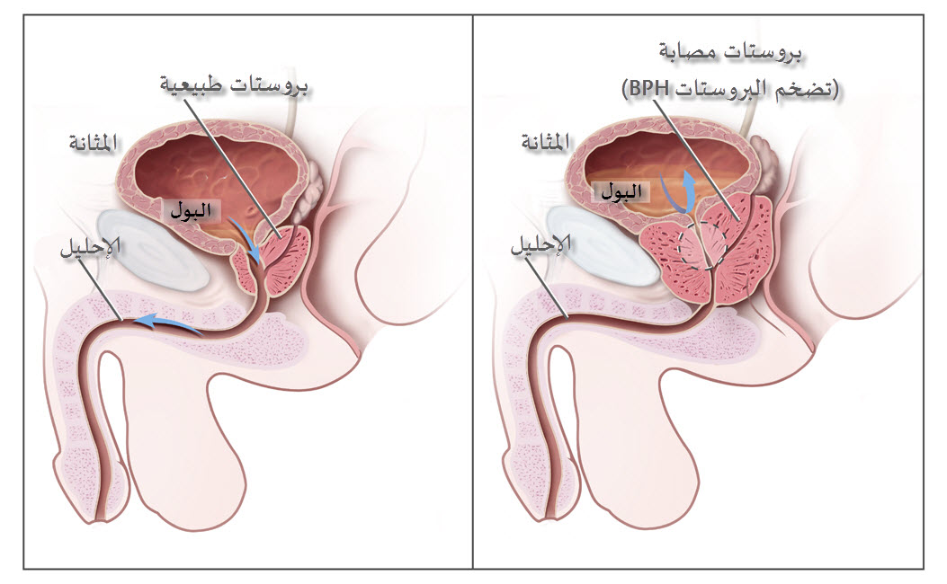 اسباب تضخم البروستاتا - التهاب البروستاتا 3492 5