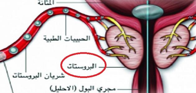 اسباب تضخم البروستاتا - التهاب البروستاتا 3492 2