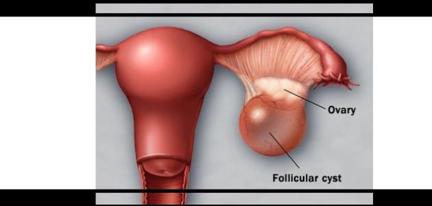 ماهي اعراض تكيس المبايض , تكيس المبيض واضراره