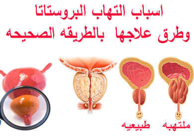 اسباب تضخم البروستاتا - التهاب البروستاتا 3492 6