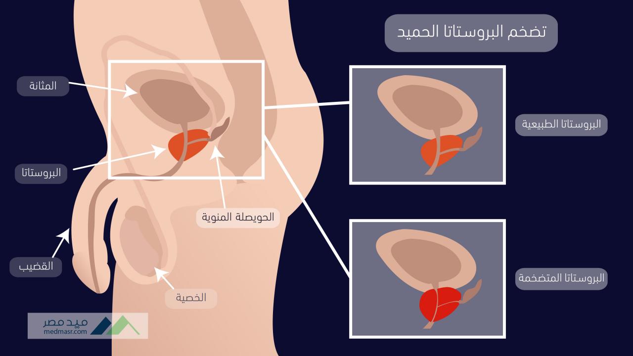 علاج تضخم البروستاتا الحميد - الوسائل الحديثة للعلاج من البروستاتا 11042 10