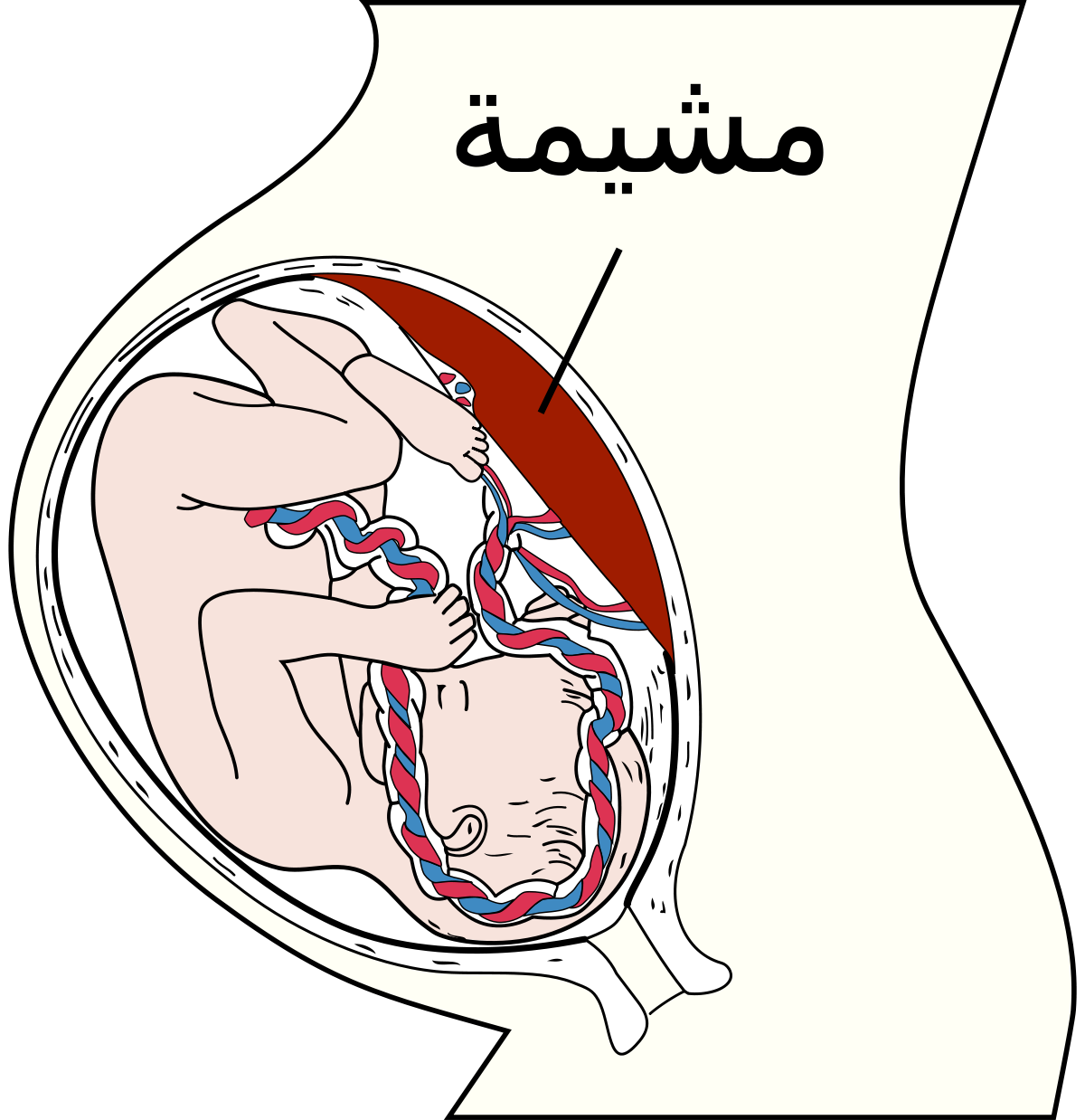 سبب نزول المشيمة - اسباب متنوعه لنزول المشيمه 12084 1