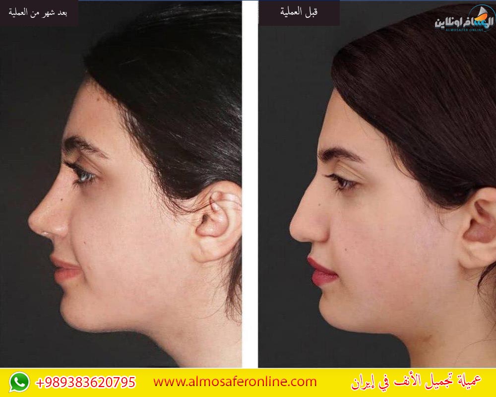 عمليات تجميل الانف في ايران وتكلفتها - افضل بلد للقيام بتجميل الانف 10969 2