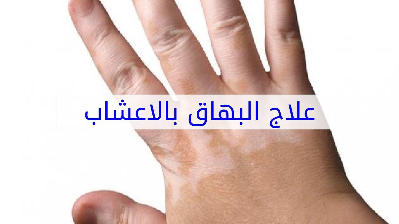 علاج البهاق بالاعشاب - القضاء على البهاق بالطب البديل 5279 3