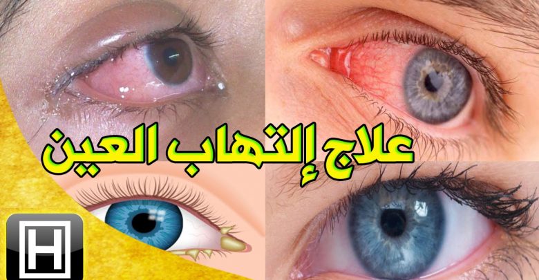 ايه هي امراض العين وعلاجها - علاج العين 889 2