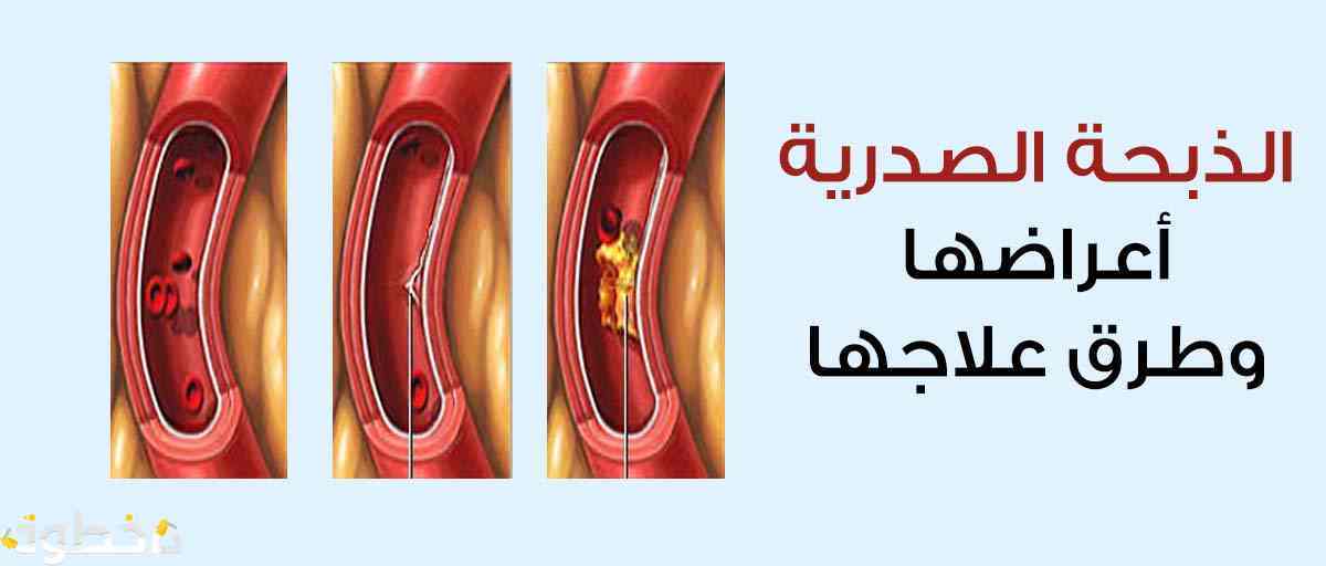 اعراض الذبحة الصدرية , الازمات الصدريه و الانقاذ منها