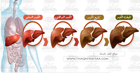 علاج تليف الكبد ماهو علاج تليف الكبد