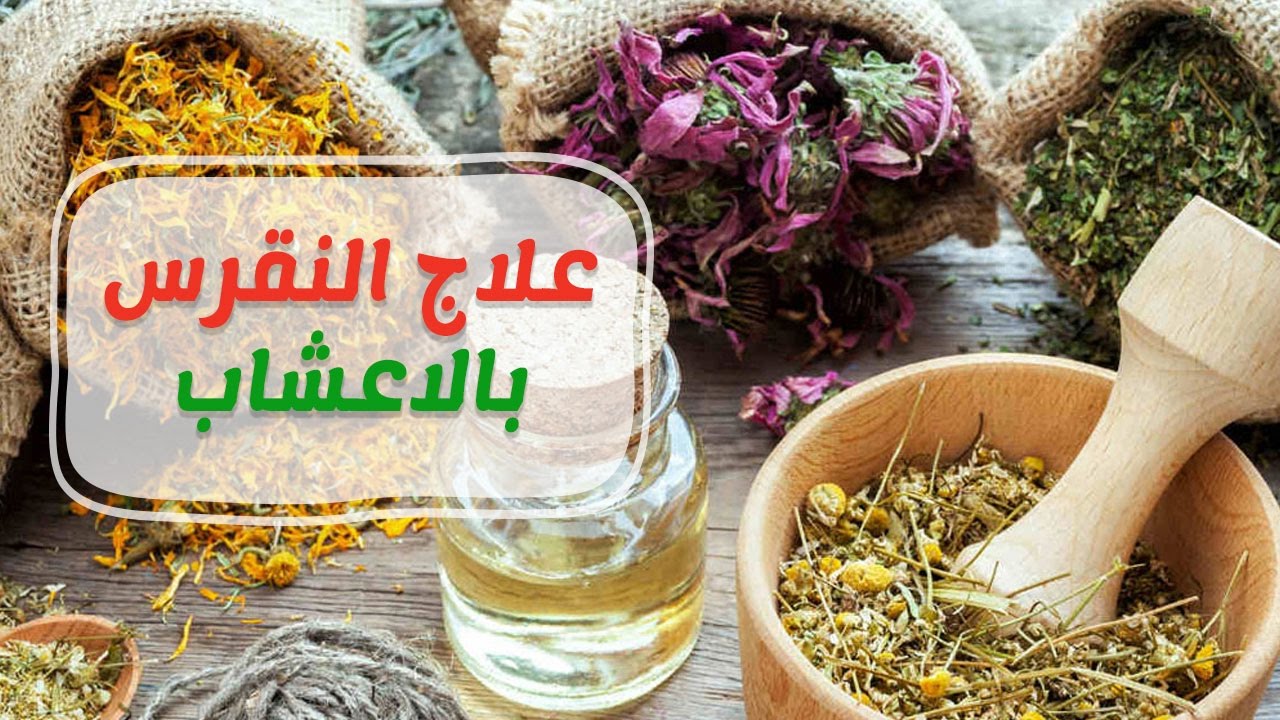 علاج النقرس بالاعشاب - علاج مرض النقرس بالطب البديل 6563 2