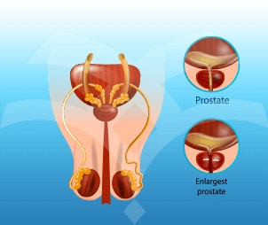 اسباب تضخم البروستاتا - التهاب البروستاتا 3492 3