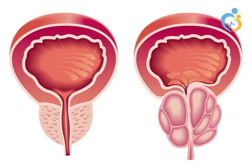 اسباب تضخم البروستاتا - التهاب البروستاتا 3492 1