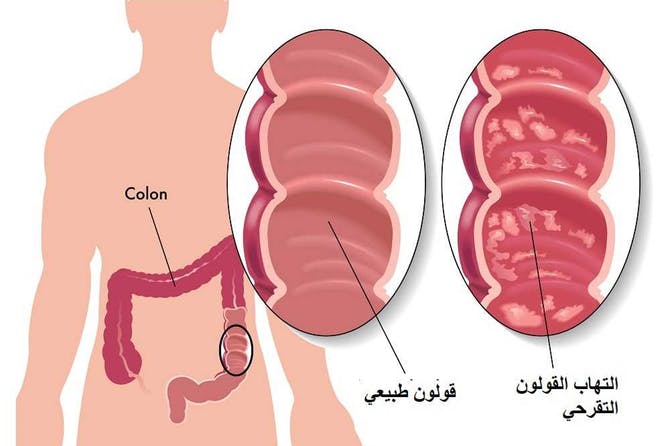 اعراض التهاب القولون - حالات التهاب القولون 3450 3