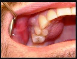 اعراض خراج الاسنان اعرف اعراض خراج الاسنان بالتفصيل وعلاجه وداع وفراق